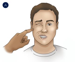 Doctor touching a man's face checking for Chvostek signs.