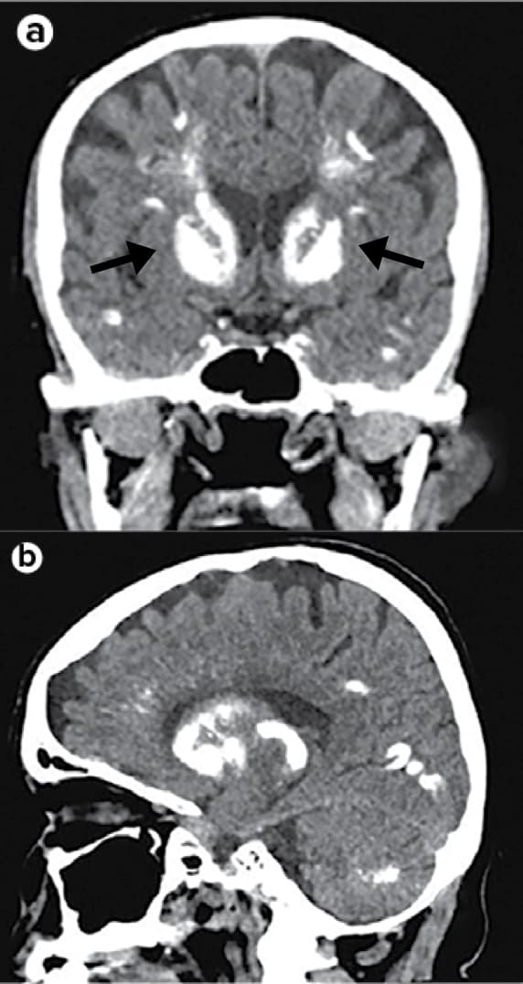 CT scan of  an individual with hypoparathyroidism.