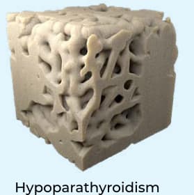 Image of hypoparathyroidism bone microarchitecture.
